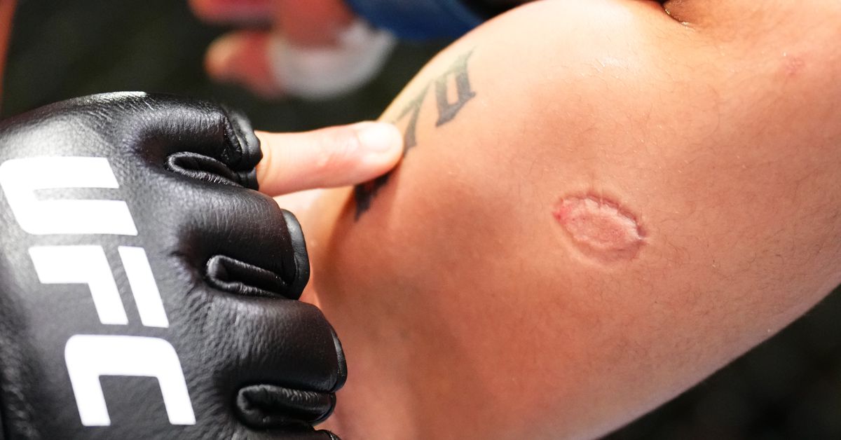 Andre Lima reacciona al ser mordido en UFC Vegas 89: 'Realmente pensé que se me había metido la valla'