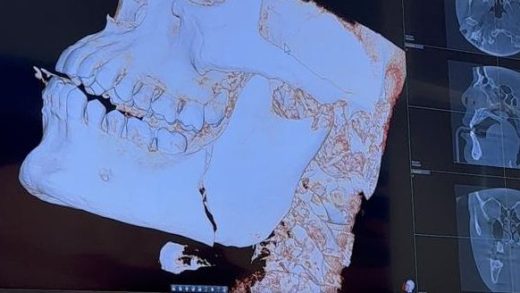 Nikolas Motta muestra rayos X de la mandíbula fracturada después del memorable choque de UFC: 'f*ck que duele'