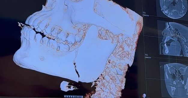 Nikolas Motta muestra rayos X de la mandíbula fracturada después del memorable choque de UFC: 'f*ck que duele'