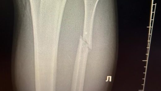 Valter Walker sufrió fractura de peroné en la victoria de UFC 321, revela cronograma de recuperación