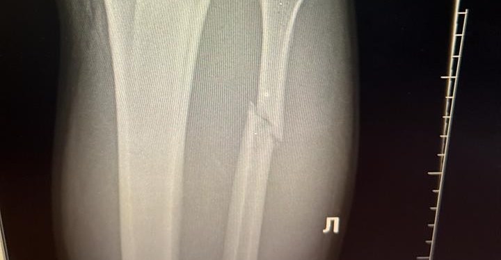 Valter Walker sufrió fractura de peroné en la victoria de UFC 321, revela cronograma de recuperación